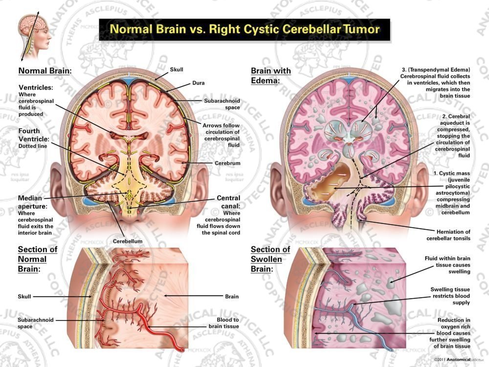 Normal Brain vs. Right Cystic Cerebellar Tumor