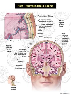 Post – Traumatic Brain Edema