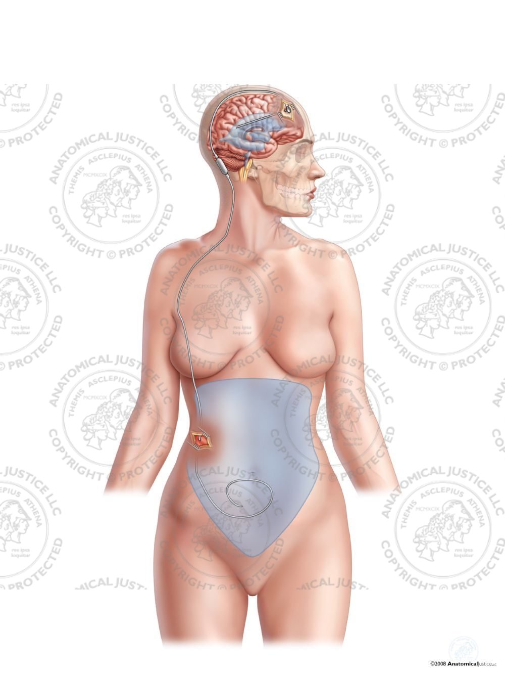 Female Right Frontal Ventriculo – Peritoneal Shunt – No Text