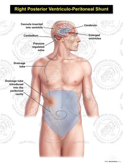 Male Right Posterior Ventriculo – Peritoneal Shunt