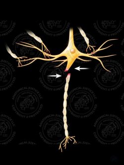 Shearing of an Axon Due To Applied Forces – Black – No Text