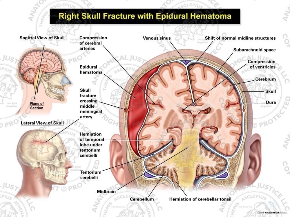 Right Skull Fracture with Epidural Hematoma