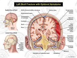 Left Skull Fracture with Epidural Hematoma