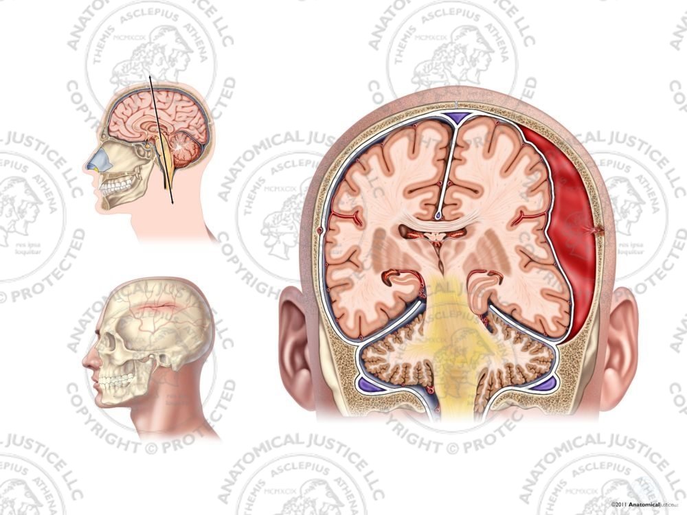 Left Skull Fracture with Epidural Hematoma – No Text