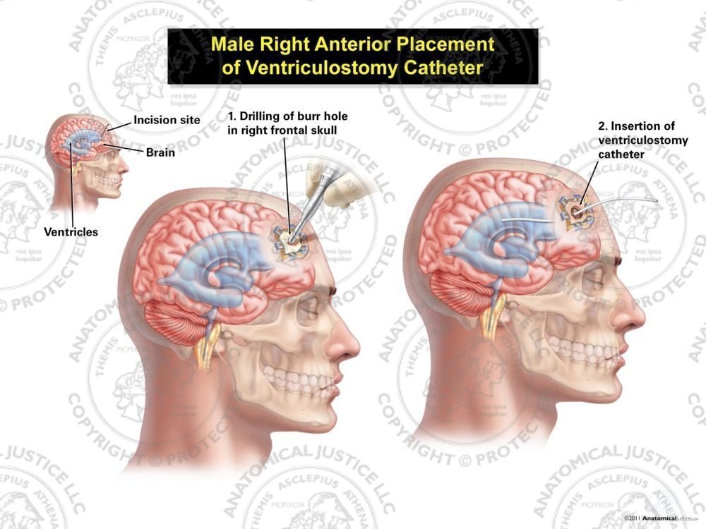 Male Right Anterior Placement of Ventriculostomy Catheter