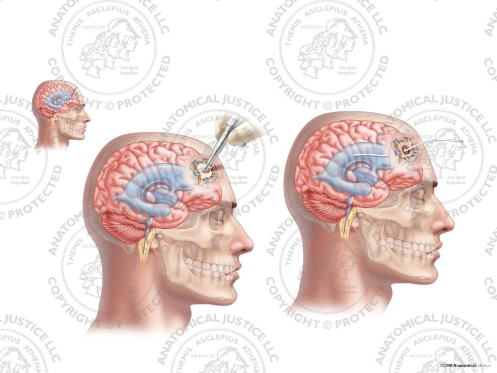 Male Right Anterior Placement of Ventriculostomy Catheter – No Text