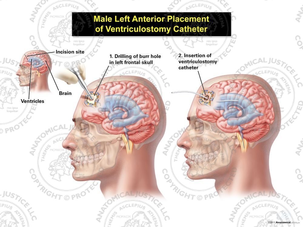 Male Left Anterior Placement of Ventriculostomy Catheter