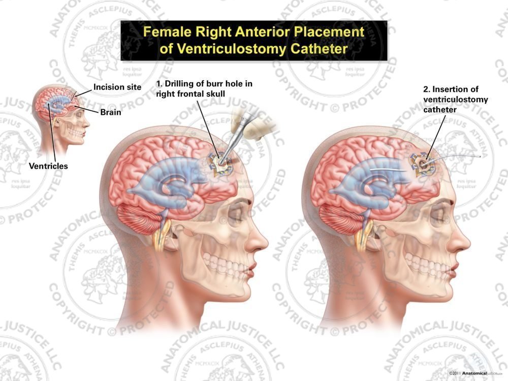 Female Right Anterior Placement of Ventriculostomy Catheter