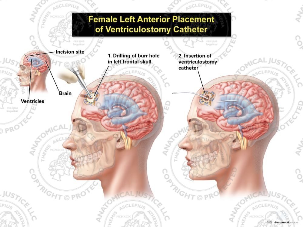 Female Left Anterior Placement of Ventriculostomy Catheter