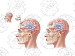 Female Left Anterior Placement of Ventriculostomy Catheter – No Text
