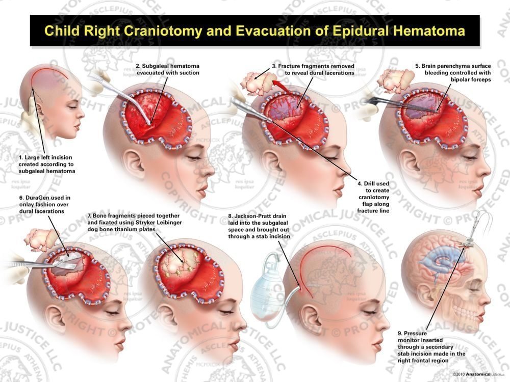 Child Right Craniotomy and Evacuation of Subgaleal Hematoma