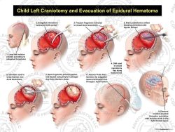 Child Left Craniotomy and Evacuation of Subgaleal Hematoma