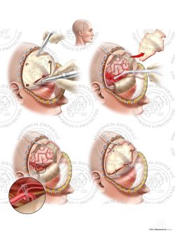 Right Craniotomy with Aneurysm Clipping and Ventriculostomy – No Text