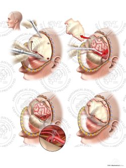 Left Craniotomy with Aneurysm Clipping and Ventriculostomy – No Text