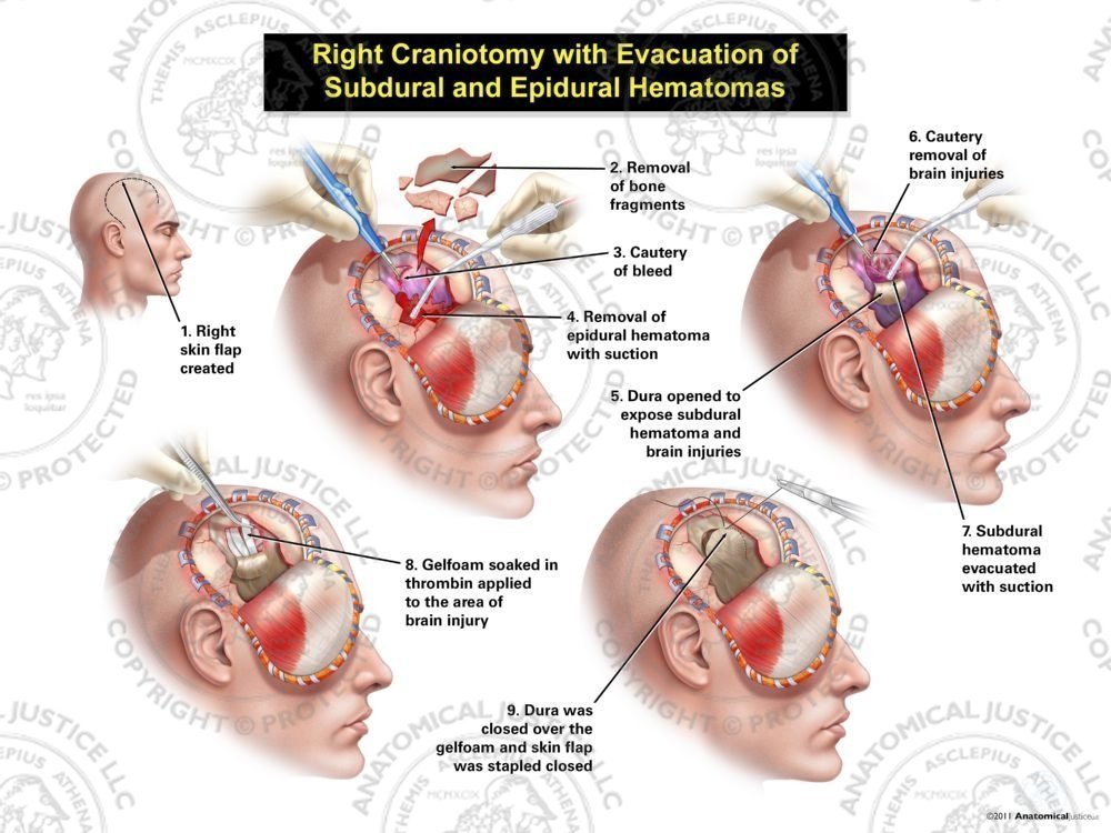 Male Right Craniotomy with Evacuation of Subdural and Epidural Hematomas
