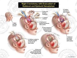Female Right Craniotomy with Evacuation of Subdural and Epidural Hematomas