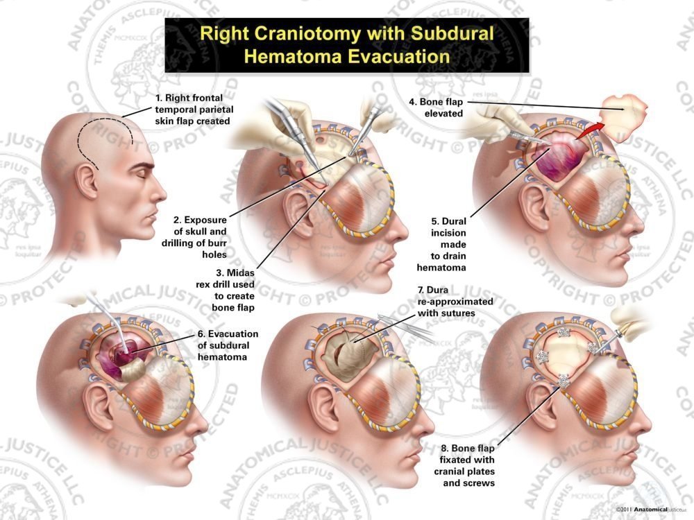Male Right Craniotomy with Subdural Hematoma Evacuation