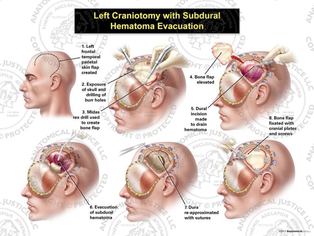 Male Left Craniotomy with Subdural Hematoma Evacuation