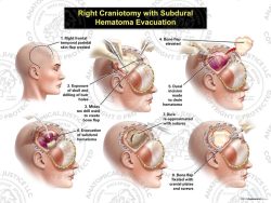 Female Right Craniotomy with Subdural Hematoma Evacuation