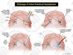 Drainage of Infant Subdural Hematomas