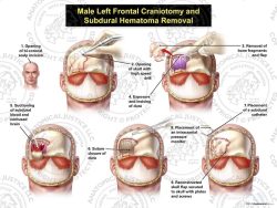 Male Right Frontal Craniotomy and Subdural Hematoma Removal