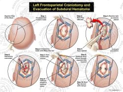 Left Frontoparietal Craniotomy and Evacuation of Subdural Hematoma