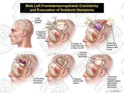 Male Left Frontotemporoparietal Craniotomy and Evacuation of Subdural Hematoma