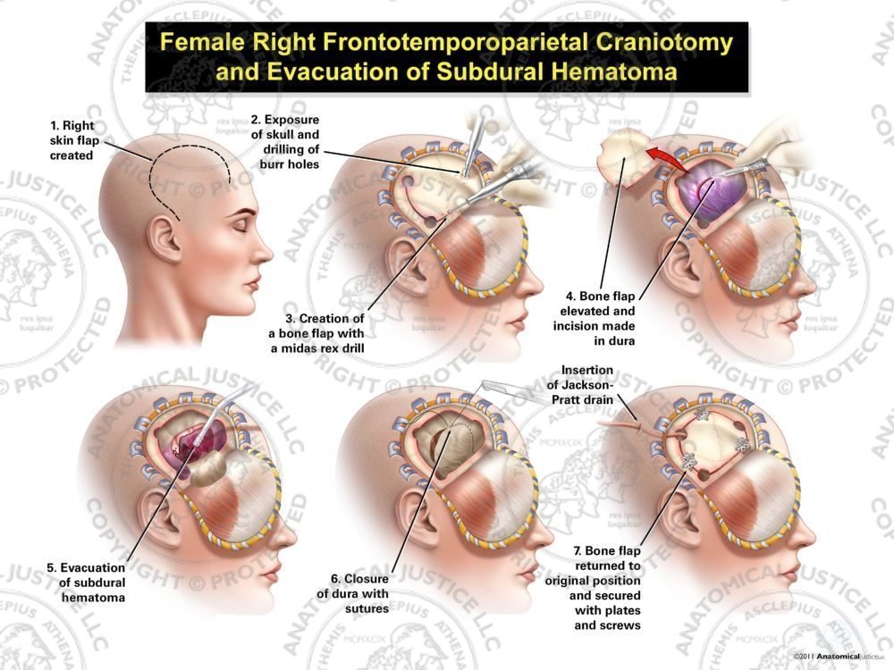 Female Right Frontotemporoparietal Craniotomy and Evacuation of Subdural Hematoma