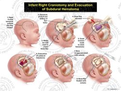 Infant Right Craniotomy and Evacuation of Subdural Hematoma
