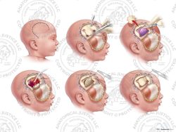 Infant Right Craniotomy and Evacuation of Subdural Hematoma – No Text