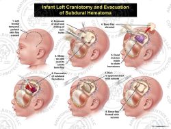 Infant Left Craniotomy and Evacuation of Subdural Hematoma