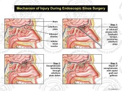Mechanism of Injury During Endoscopic Sinus Surgery