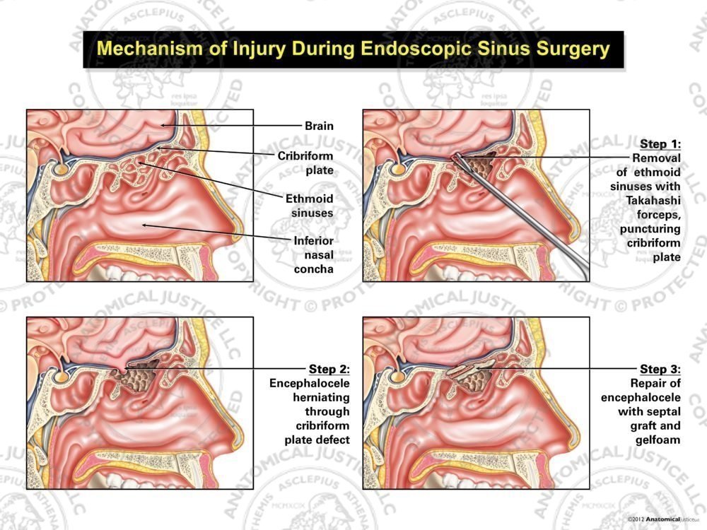 Mechanism of Injury During Endoscopic Sinus Surgery