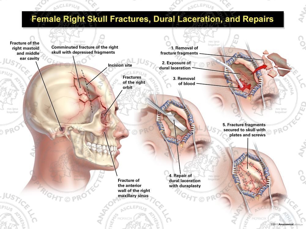 Male Right Skull Fractures, Dural Laceration, and Repairs
