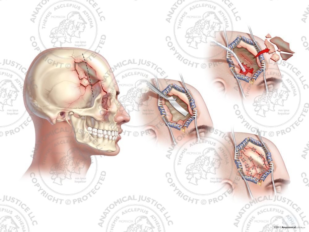 Male Right Skull Fractures, Dural Laceration, and Repairs – No Text