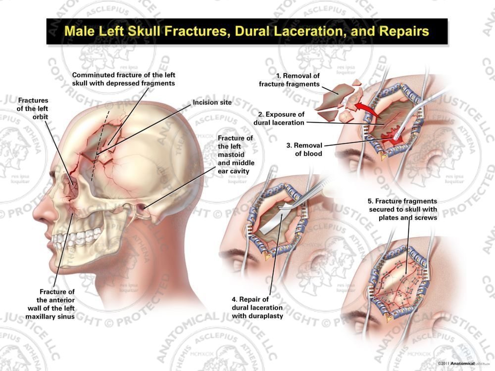 Male Left Skull Fractures, Dural Laceration, and Repairs