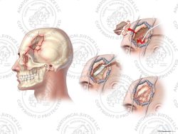 Male Left Skull Fractures, Dural Laceration, and Repairs – No Text