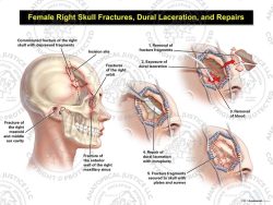 Female Right Skull Fractures, Dural Laceration, and Repairs