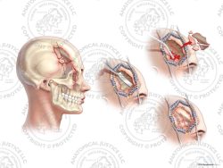 Female Right Skull Fractures, Dural Laceration, and Repairs – No Text
