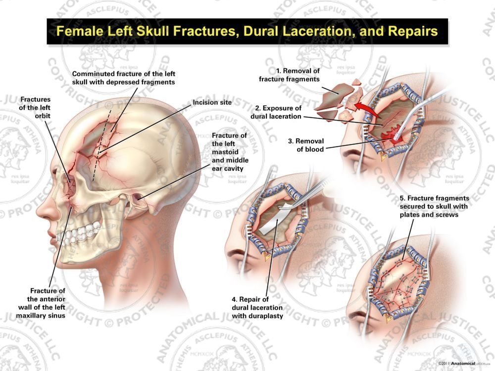 Female Left Skull Fractures, Dural Laceration, and Repairs