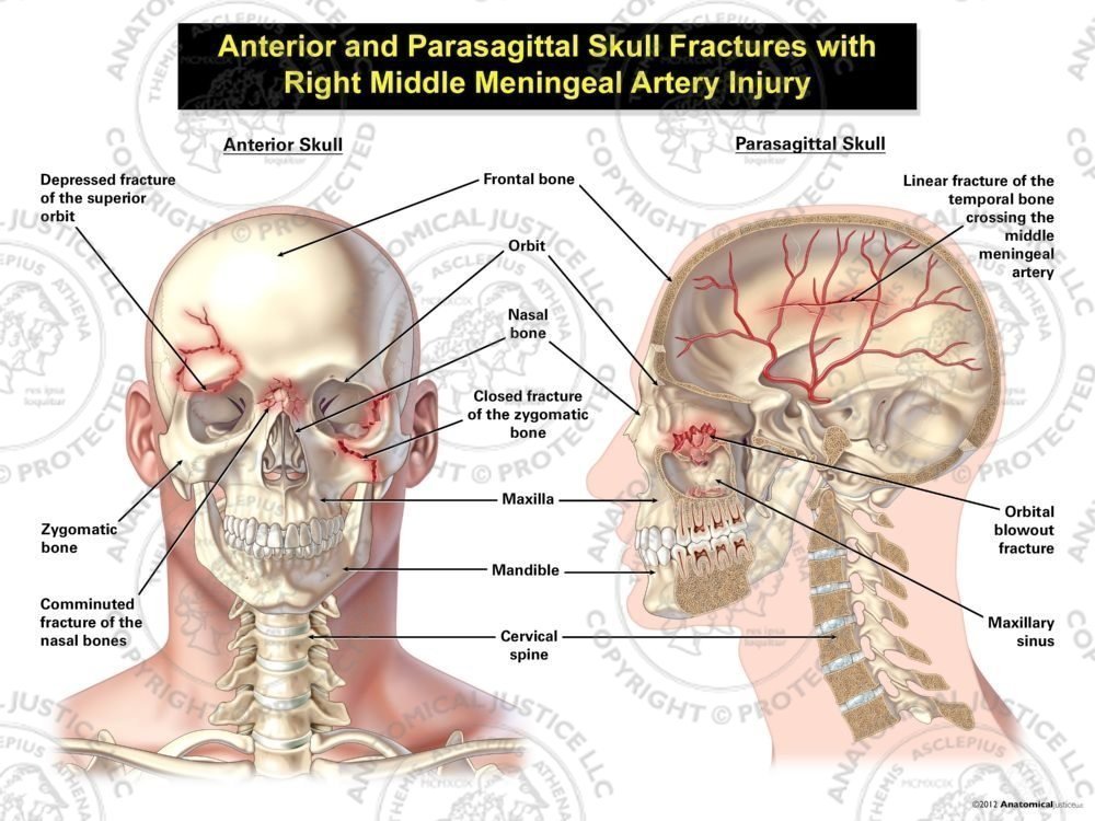 Anterior and Parasagittal Skull Fractures with Right Middle Meningeal Artery Injury