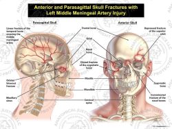 Anterior and Parasagittal Skull Fractures with Left Middle Meningeal Artery Injury