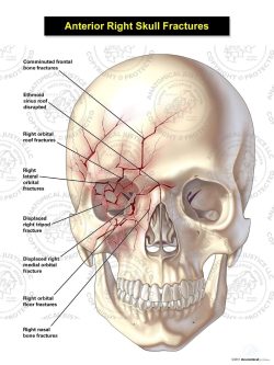 Anterior Right Skull Fractures