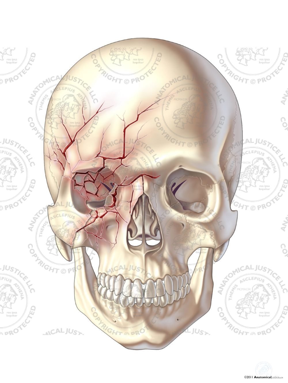 Anterior Right Skull Fractures – No Text