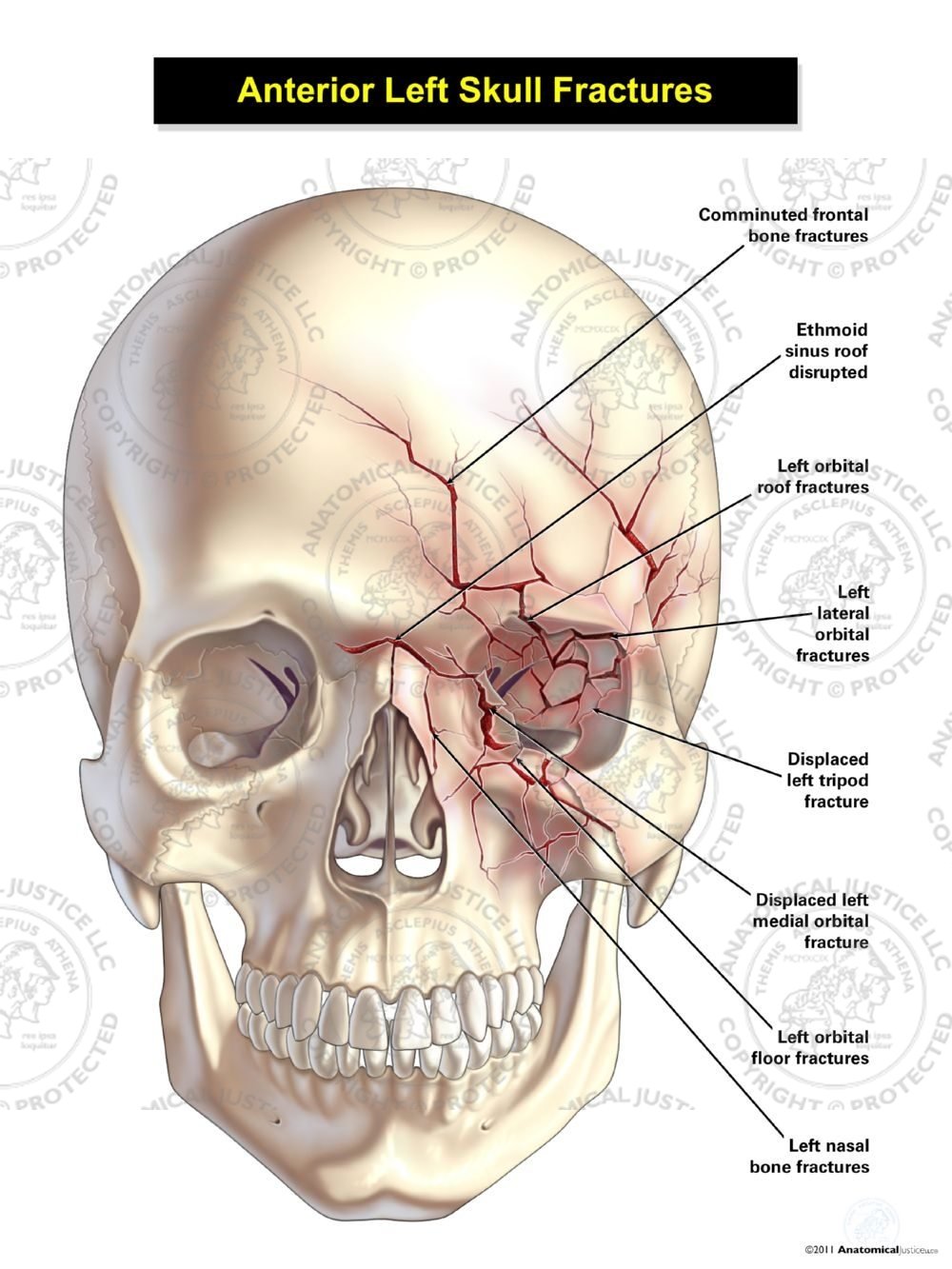 Anterior Left Skull Fractures