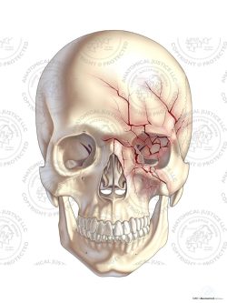 Anterior Left Skull Fractures – No Text