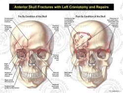 Anterior Skull Fractures with Right Craniotomy and Repairs