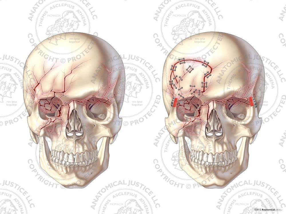 Anterior Skull Fractures with Right Craniotomy and Repairs – No Text