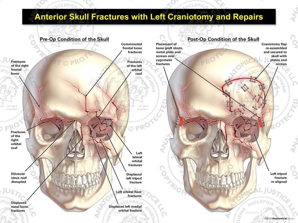 Anterior Skull Fractures with Left Craniotomy and Repairs