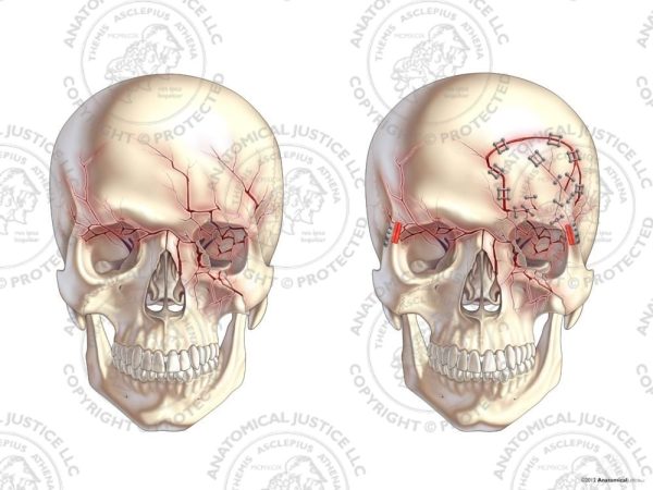 anterior-skull-fractures-with-left-craniotomy-and-repairs-no-text